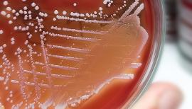 Percutaneous Mechanical Aspiration Promising for Right-Heart Infective Endocarditis